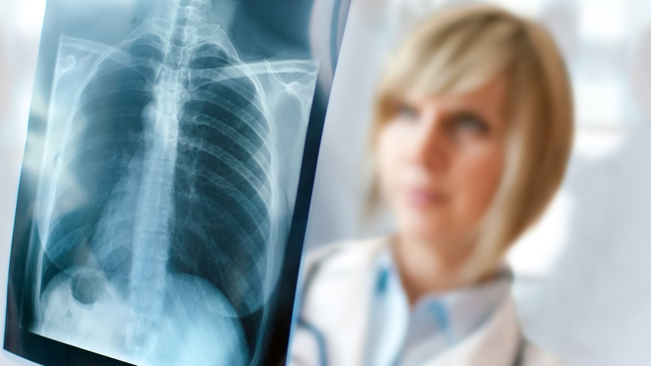Професійні захворювання легень: роль та ефективність респіраторної підтримки